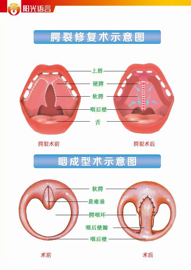 先天性唇腭裂